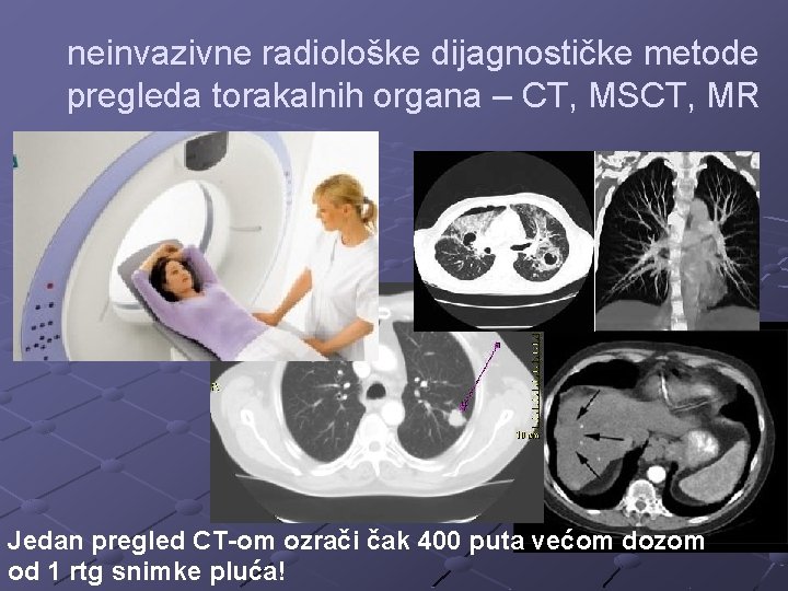neinvazivne radiološke dijagnostičke metode pregleda torakalnih organa – CT, MSCT, MR Jedan pregled CT-om