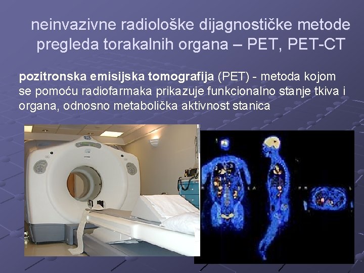 neinvazivne radiološke dijagnostičke metode pregleda torakalnih organa – PET, PET-CT pozitronska emisijska tomografija (PET)
