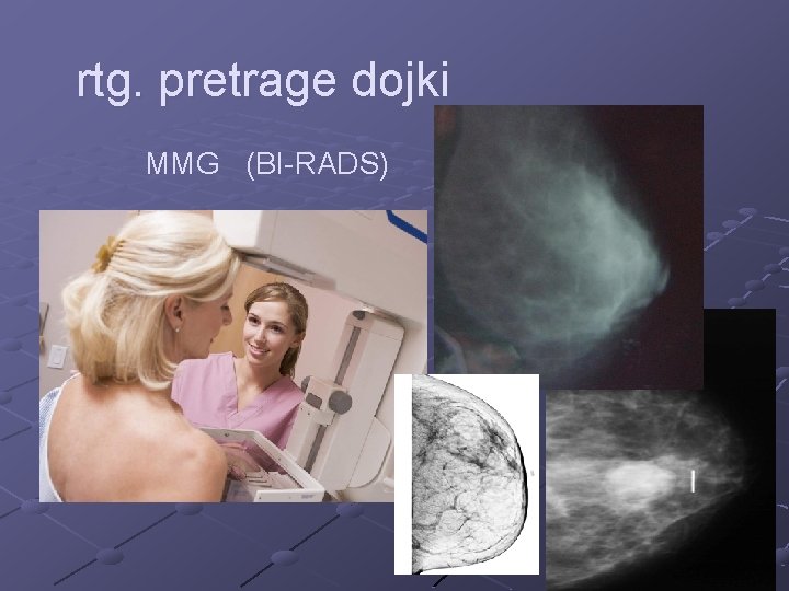 rtg. pretrage dojki MMG (BI-RADS) 