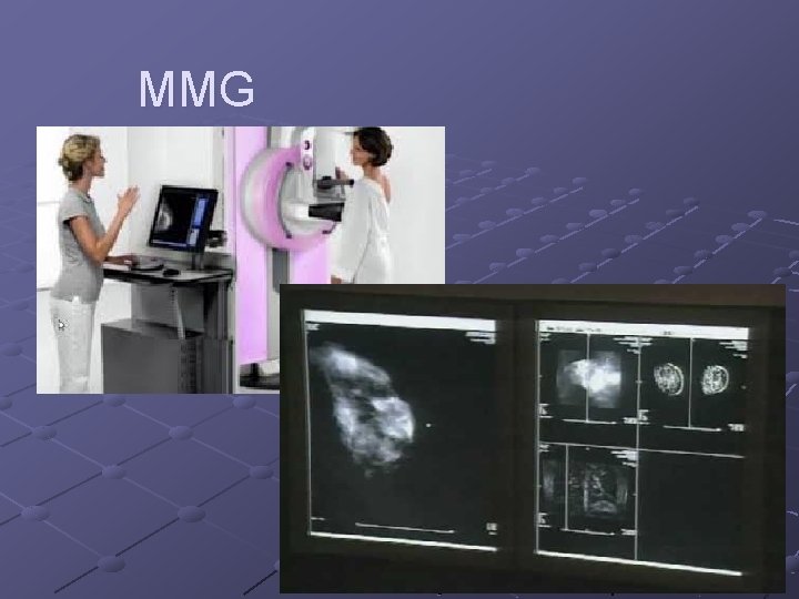  MMG 