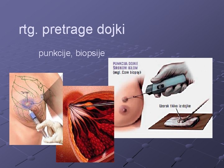 rtg. pretrage dojki punkcije, biopsije 