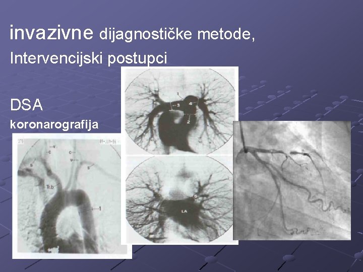 invazivne dijagnostičke metode, Intervencijski postupci DSA koronarografija 