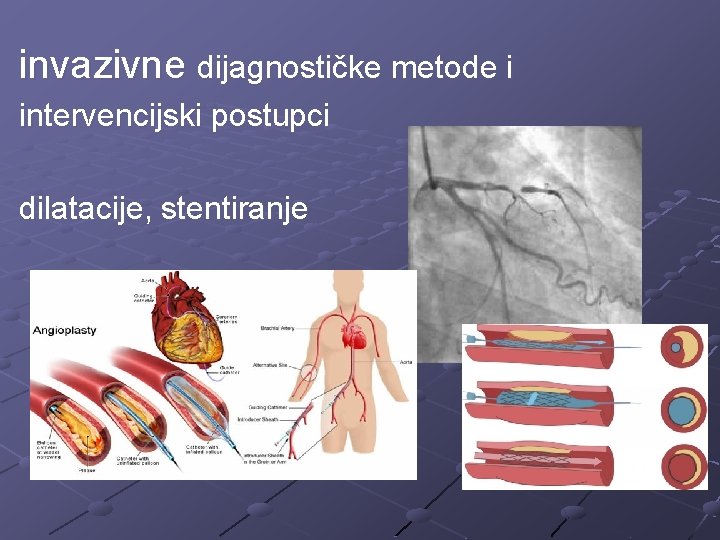 invazivne dijagnostičke metode i intervencijski postupci dilatacije, stentiranje 