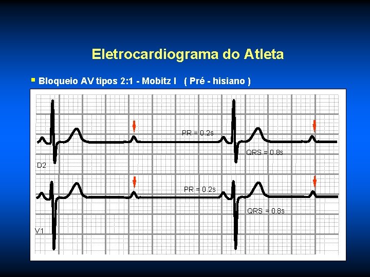 Eletrocardiograma do Atleta § Bloqueio AV tipos 2: 1 - Mobitz I ( Pré