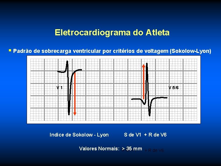 Eletrocardiograma do Atleta § Padrão de sobrecarga ventricular por critérios de voltagem (Sokolow-Lyon) V