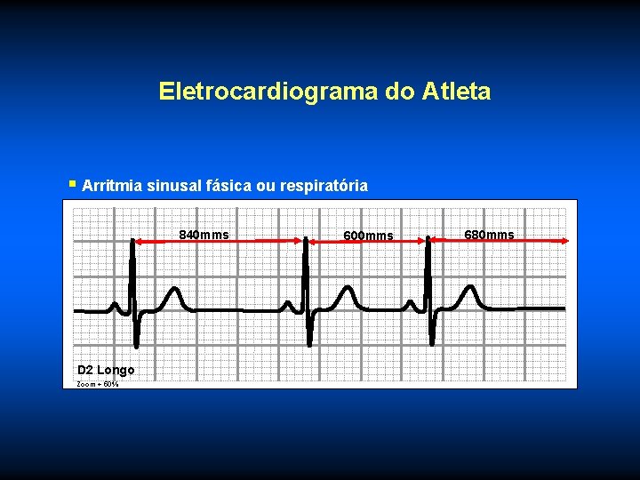 Eletrocardiograma do Atleta § Arritmia sinusal fásica ou respiratória 840 mms D 2 Longo