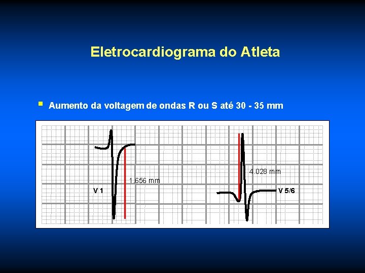 Eletrocardiograma do Atleta § Aumento da voltagem de ondas R ou S até 30