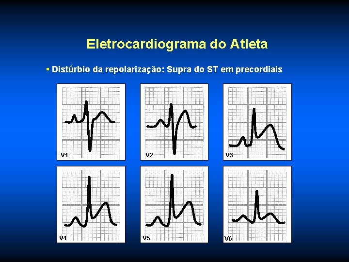 Eletrocardiograma do Atleta § Distúrbio da repolarização: Supra do ST em precordiais V 1
