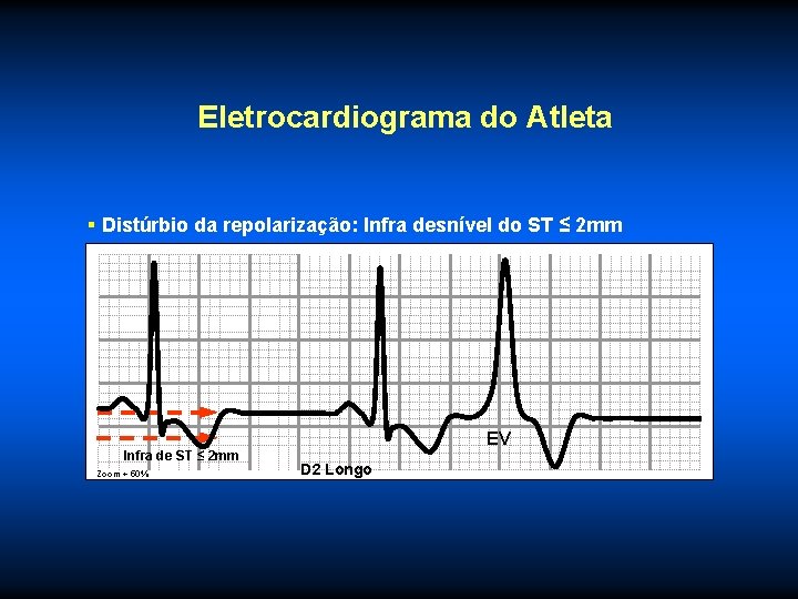 Eletrocardiograma do Atleta § Distúrbio da repolarização: Infra desnível do ST ≤ 2 mm