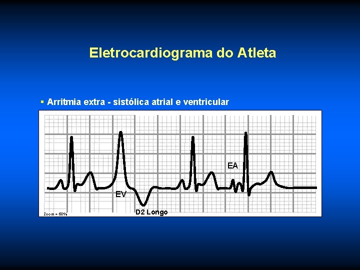 Eletrocardiograma do Atleta § Arritmia extra - sistólica atrial e ventricular EA EV Zoom