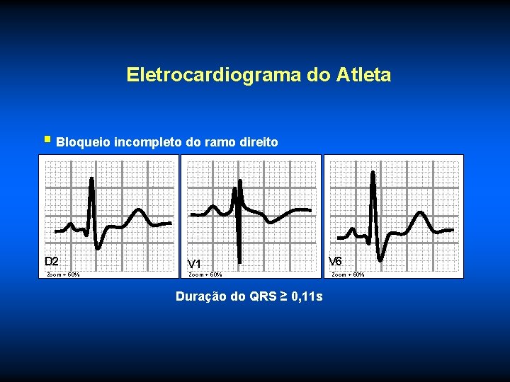 Eletrocardiograma do Atleta § Bloqueio incompleto do ramo direito D 2 Zoom + 50%