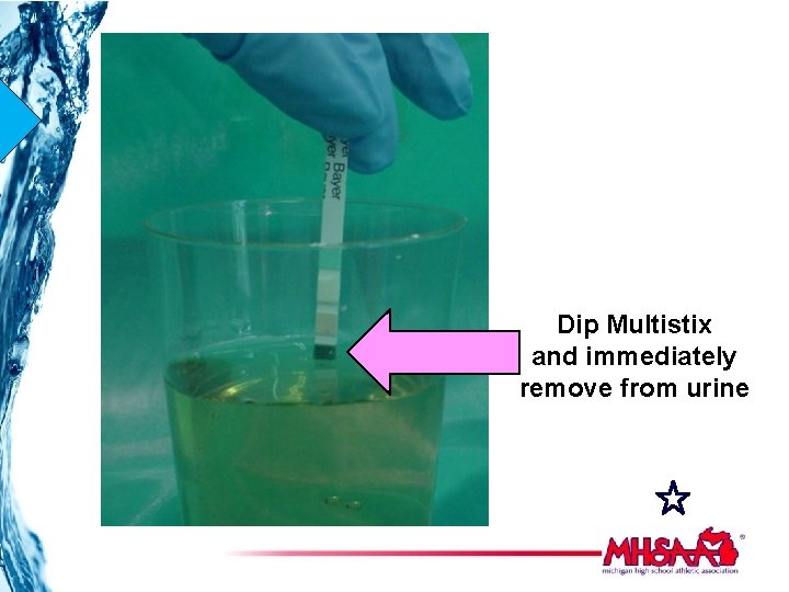 Dip Multistix and immediately remove from urine 