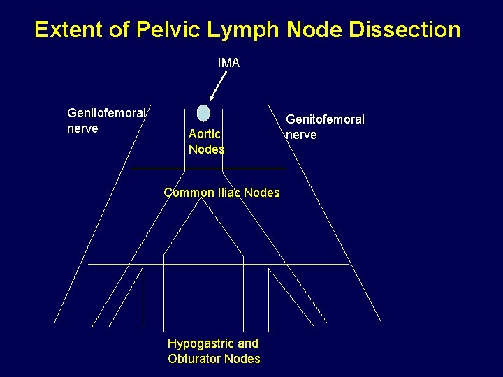 Extent of Pelvic Lymph Node Dissection IMA Genitofemoral nerve Aortic Nodes Common Iliac Nodes