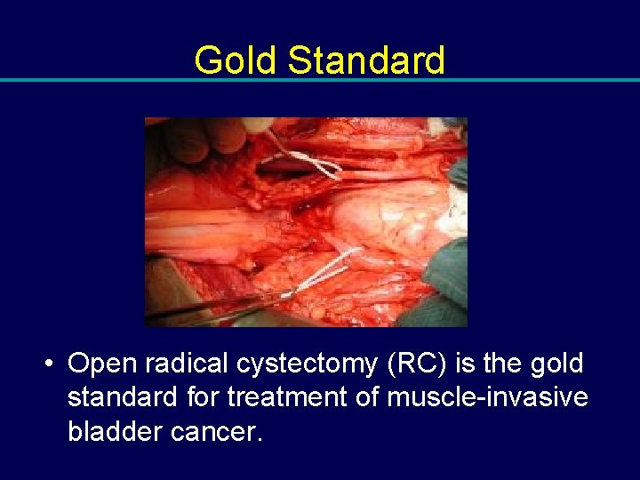 Gold Standard • Open radical cystectomy (RC) is the gold standard for treatment of