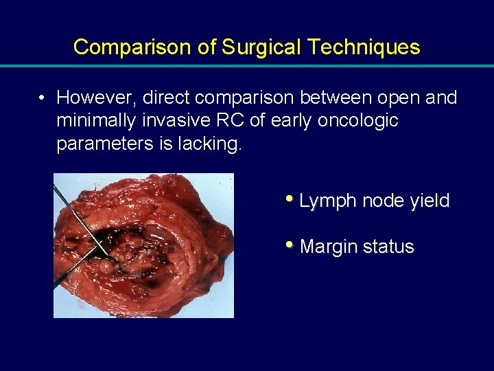 Comparison of Surgical Techniques • However, direct comparison between open and minimally invasive RC