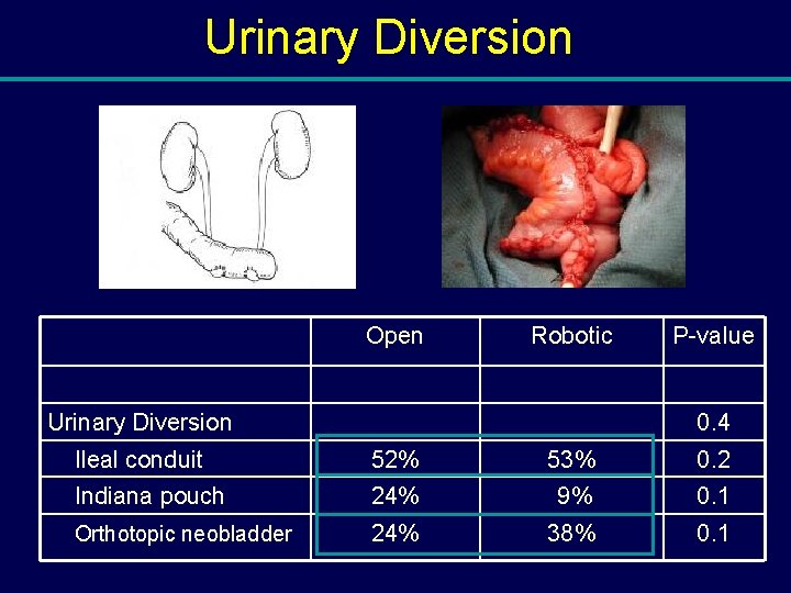 Urinary Diversion Open Robotic Urinary Diversion P-value 0. 4 Ileal conduit 52% 53% 0.