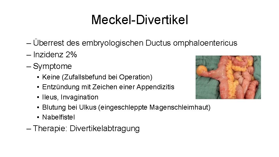 Meckel-Divertikel – Überrest des embryologischen Ductus omphaloentericus – Inzidenz 2% – Symptome • •
