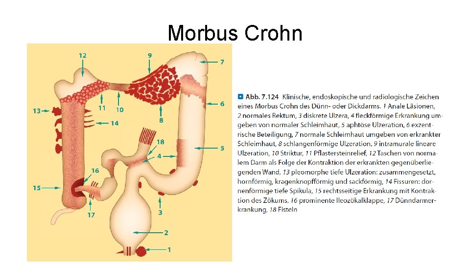 Morbus Crohn 