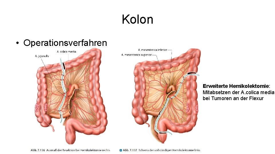 Kolon • Operationsverfahren Erweiterte Hemikolektomie: Mitabsetzen der A. colica media bei Tumoren an der