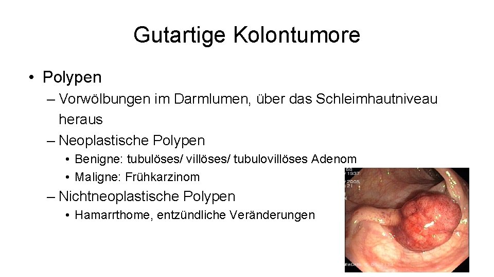 Gutartige Kolontumore • Polypen – Vorwölbungen im Darmlumen, über das Schleimhautniveau heraus – Neoplastische