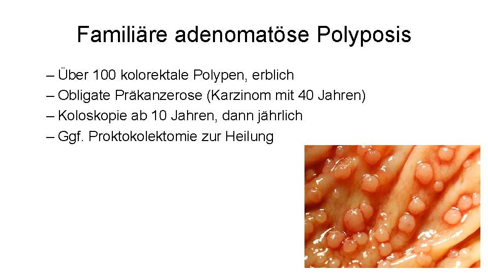 Familiäre adenomatöse Polyposis – Über 100 kolorektale Polypen, erblich – Obligate Präkanzerose (Karzinom mit