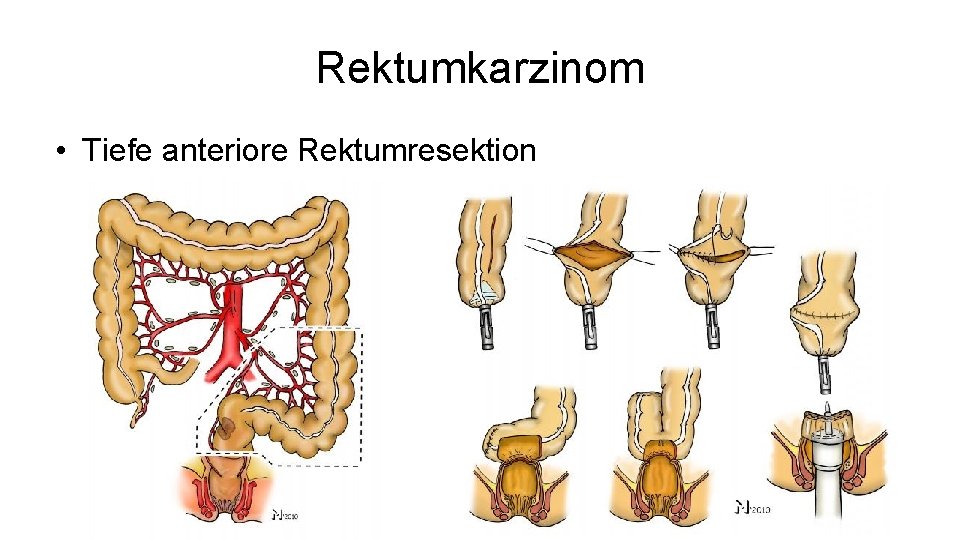 Rektumkarzinom • Tiefe anteriore Rektumresektion 