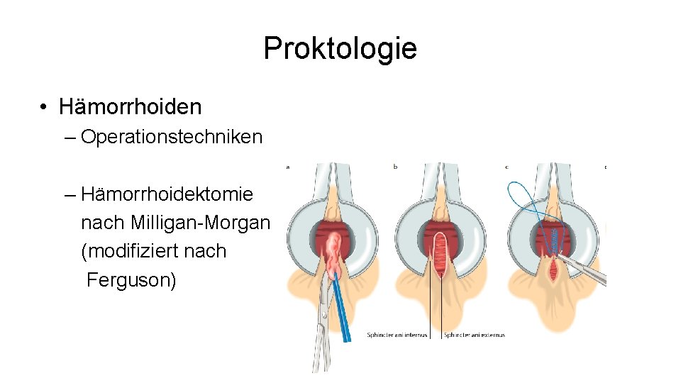 Proktologie • Hämorrhoiden – Operationstechniken – Hämorrhoidektomie nach Milligan-Morgan (modifiziert nach Ferguson) 