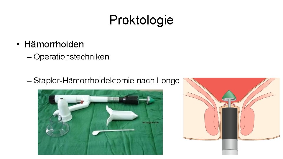 Proktologie • Hämorrhoiden – Operationstechniken – Stapler-Hämorrhoidektomie nach Longo 