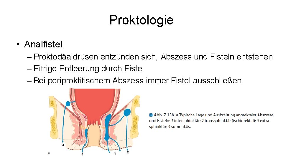 Proktologie • Analfistel – Proktodäaldrüsen entzünden sich, Abszess und Fisteln entstehen – Eitrige Entleerung