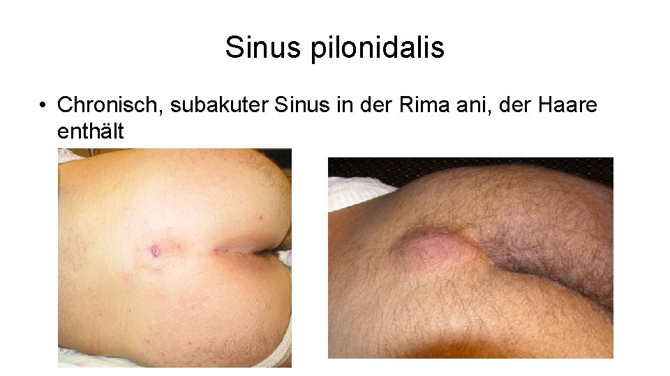 Sinus pilonidalis • Chronisch, subakuter Sinus in der Rima ani, der Haare enthält 