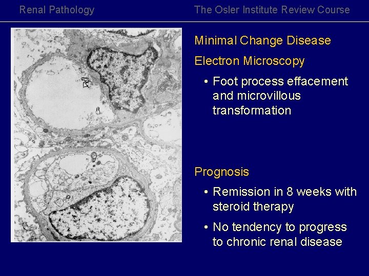Renal Pathology The Osler Institute Review Course Minimal Change Disease Electron Microscopy • Foot Renal Pathology The Osler Institute Review Course Minimal Change Disease Electron Microscopy • Foot