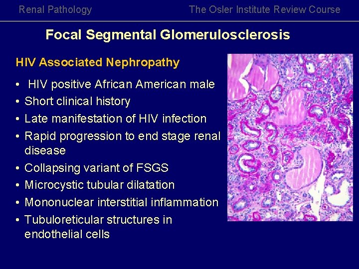 Renal Pathology The Osler Institute Review Course Focal Segmental Glomerulosclerosis HIV Associated Nephropathy •