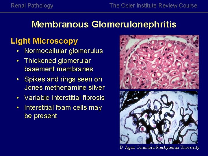 Renal Pathology The Osler Institute Review Course Membranous Glomerulonephritis Light Microscopy • Normocellular glomerulus