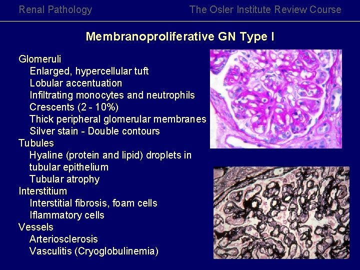 Renal Pathology The Osler Institute Review Course Membranoproliferative GN Type I Glomeruli Enlarged, hypercellular Renal Pathology The Osler Institute Review Course Membranoproliferative GN Type I Glomeruli Enlarged, hypercellular