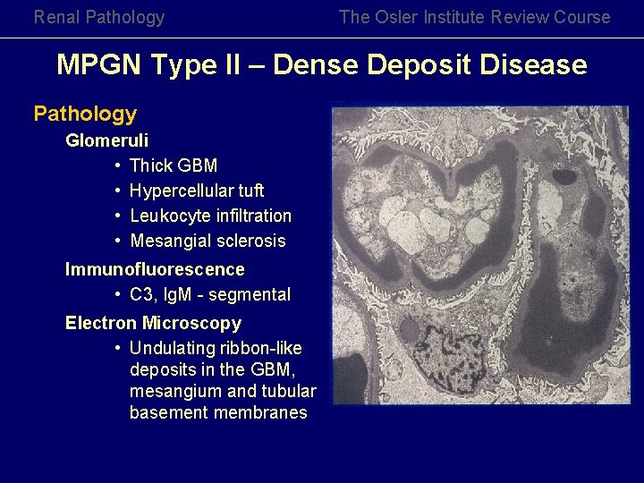 Renal Pathology The Osler Institute Review Course MPGN Type II – Dense Deposit Disease