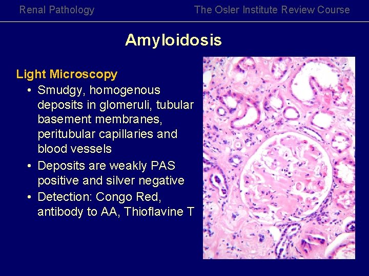 Renal Pathology The Osler Institute Review Course Amyloidosis Light Microscopy • Smudgy, homogenous deposits Renal Pathology The Osler Institute Review Course Amyloidosis Light Microscopy • Smudgy, homogenous deposits