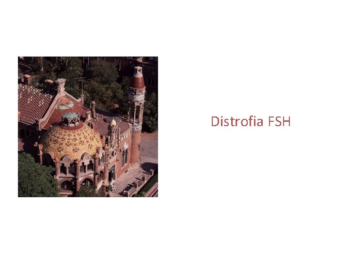 Distrofia FSH 