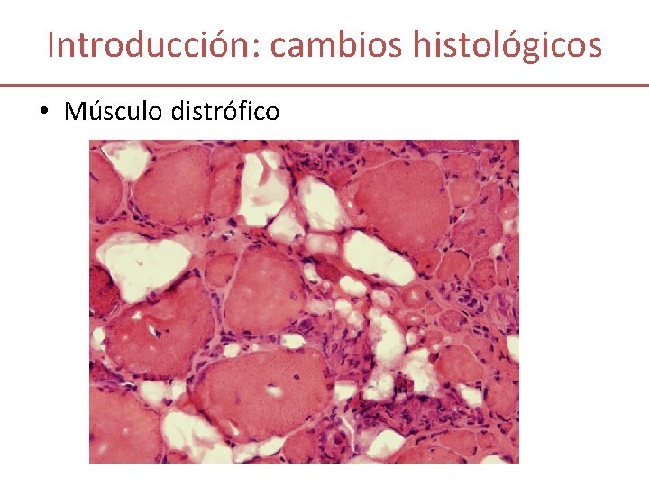Introducción: cambios histológicos • Músculo distrófico 