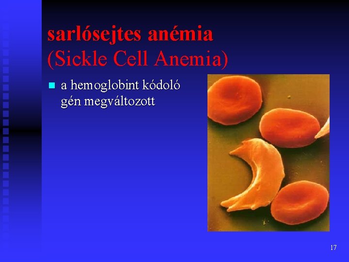 sarlósejtes anémia (Sickle Cell Anemia) n a hemoglobint kódoló gén megváltozott 17 