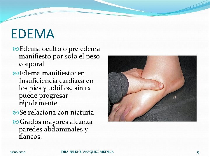 EDEMA Edema oculto o pre edema manifiesto por solo el peso corporal Edema manifiesto: