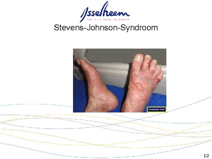 Stevens-Johnson-Syndroom 12 Stevens-Johnson-Syndroom 12