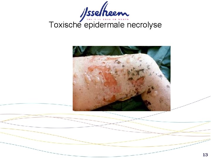 Toxische epidermale necrolyse 13 Toxische epidermale necrolyse 13