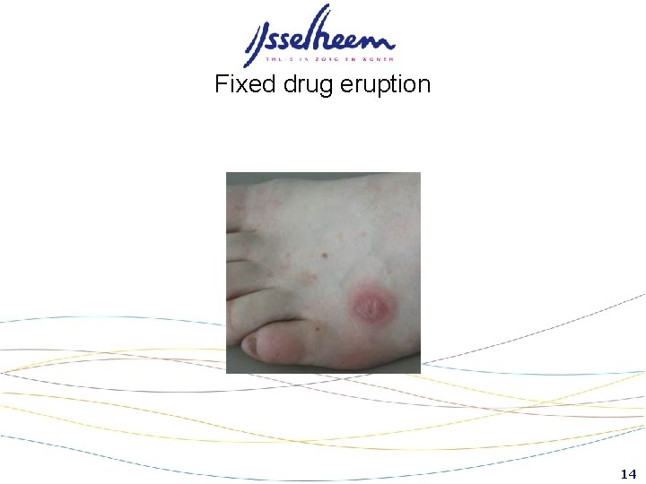 Fixed drug eruption 14 Fixed drug eruption 14