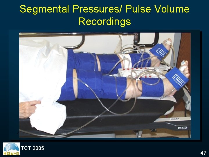 Segmental Pressures/ Pulse Volume Recordings TCT 2005 47 