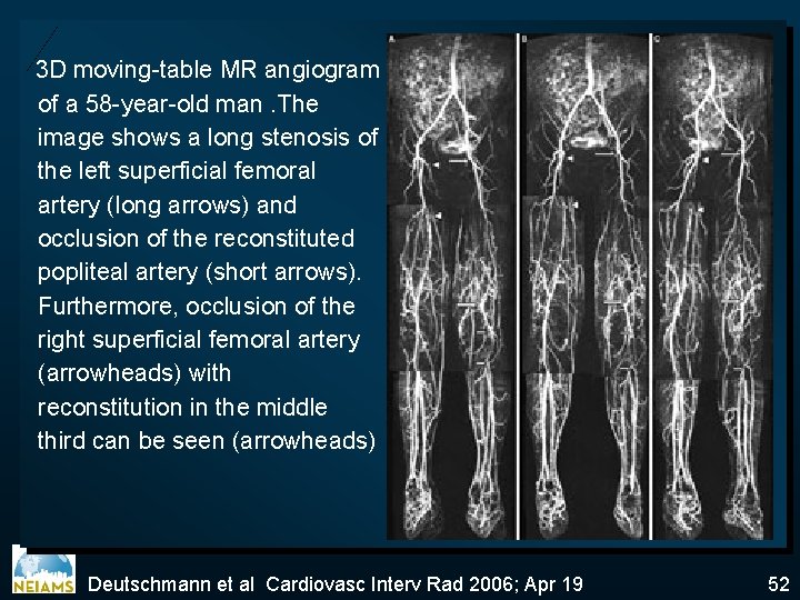 3 D moving-table MR angiogram of a 58 -year-old man. The image shows a