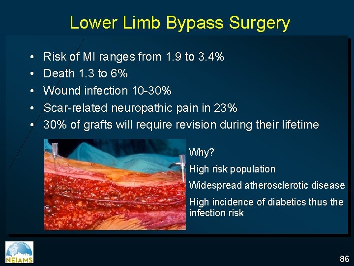 Lower Limb Bypass Surgery • • • Risk of MI ranges from 1. 9