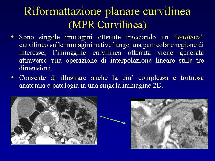 Riformattazione planare curvilinea (MPR Curvilinea) • Sono singole immagini ottenute tracciando un “sentiero” •