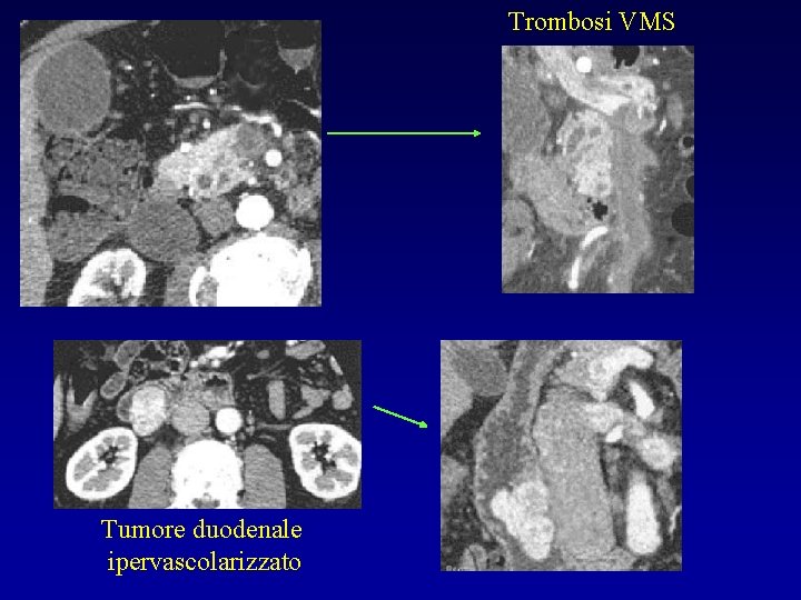 Trombosi VMS Tumore duodenale ipervascolarizzato 