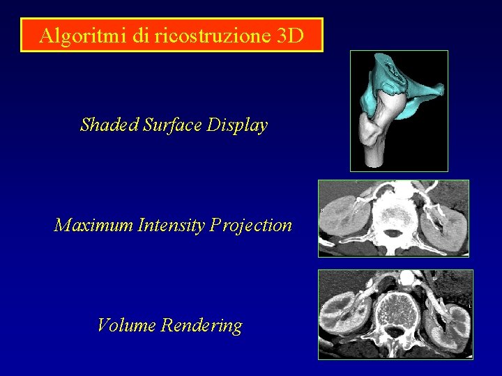 Algoritmi di ricostruzione 3 D Shaded Surface Display Maximum Intensity Projection Volume Rendering 