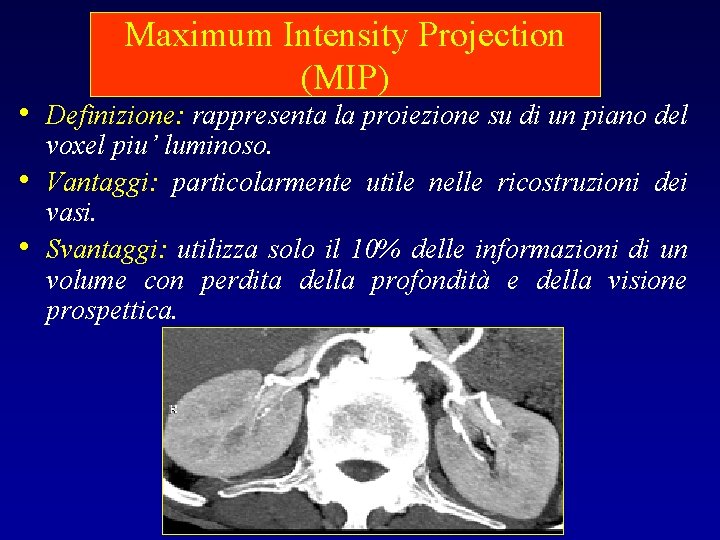 Maximum Intensity Projection (MIP) • Definizione: rappresenta la proiezione su di un piano del